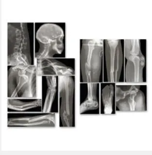 Nasco - Roylco - SB43367 - Broken Bones X-Rays Roylco