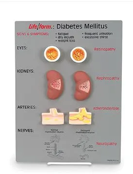 Nasco - Life/Form - WA20495 - Diabetes Mellitus Teaching Kit Life/form