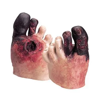 Nasco - Life/Form - WA21216 - Unhealthy Foot Care Kit Life/form Life - Size