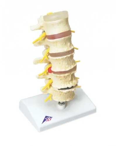 Fabrication Enterprises - From: 12-4542 To: 12-4548 - Anatomical Model vertebrae degeneration, stages of prolapsed disc