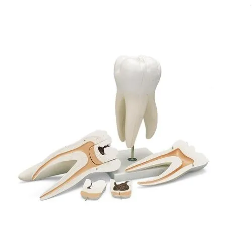 American 3B Scientific - From: D15 To: D16 - Giant Molar w. Dental Caries,