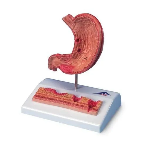 American 3B Scientific - K17 - Stomach with Ulcers