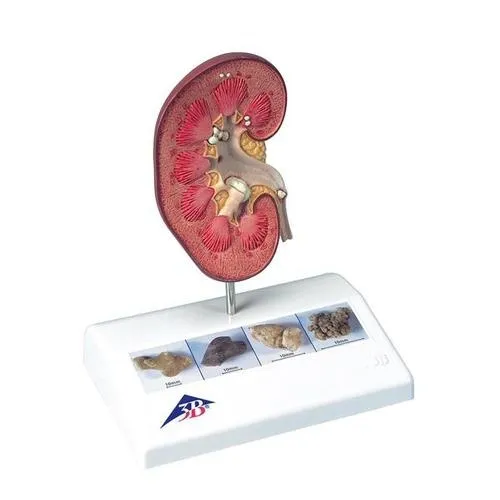 American 3B Scientific - K29 - Kidney Stone Model
