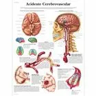 American 3B Scientific - From: VR5627L To: VR5627UU  Acidente Cerebrovascular Chart_PT_L
