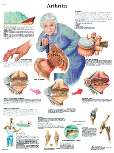 Fabrication Enterprises From: 12-4605L To: 12-4608S - Anatomical Chart - Arthritis