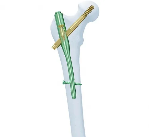 Synthes - 456.638s - Synthes 14mm/130 Deg Ti Cannulated Troch Fixation Nail 380mm/Right-Sterile